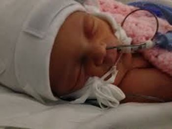 نوزاد حس مهری به دلیل نارس بودن و زود به دنیا اومدن در بیمارستان بستری شده.
