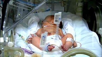 نوزاد حس مهری تازه متولد شده به دلیل نارس بودن در بخش NICU بستری شده.