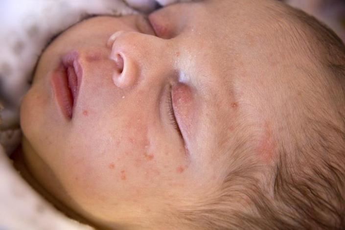 حنیفه نوزاد یکساله&nbsp;ای است که به دلیل بیماری سرخک بستری شده است.