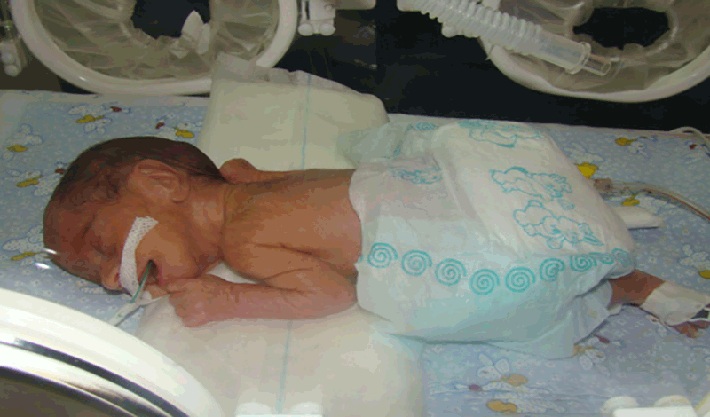 نوزاد پسر تازه متولد به دلیل نارسایی ریوی بستری شده است.