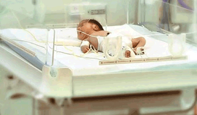 نوزاد دختر تازه متولد به دلیل هیدروسفال بستری شده است.