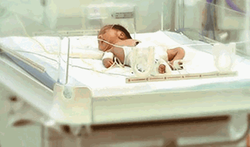 نوزاد دختر تازه متولد به دلیل هیدروسفال بستری شده است.