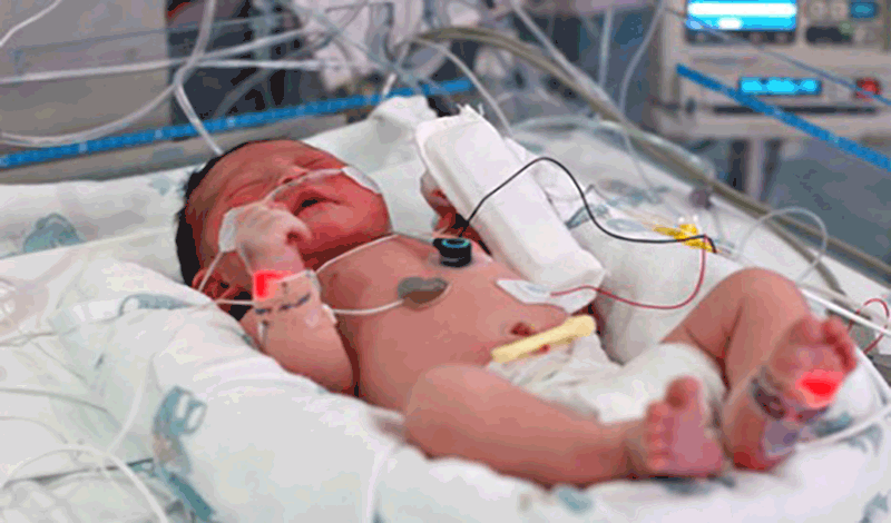 نوزاد تازه&zwnj;متولد به دلیل بیماری d-tga بستری شده است.