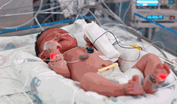 نوزاد تازه&zwnj;متولد به دلیل بیماری d-tga بستری شده است.