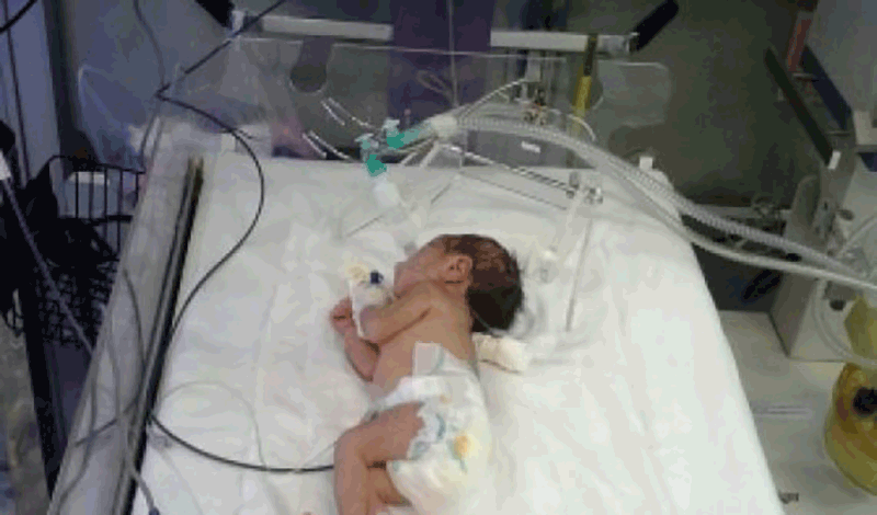 نوزاد پسر تازه&zwnj;متولد به دلیل بیماری آنومالی بستری شده است.