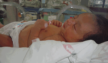 نوزاد تازه متولد به دلیل نارس بودن بستری شده است.