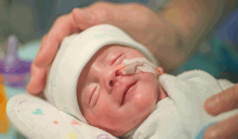 نوزاد تازه&zwnj;متولد به دلیل نارسایی ریوی بستری شده است.