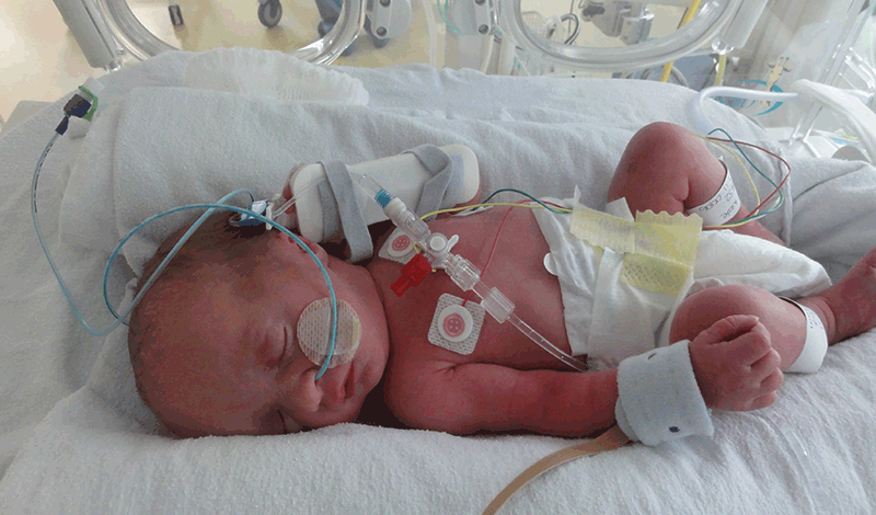 نوزاد تازه&zwnj;متولد به دلیل عفونت ریه و تنگی نفس بستری شده است.