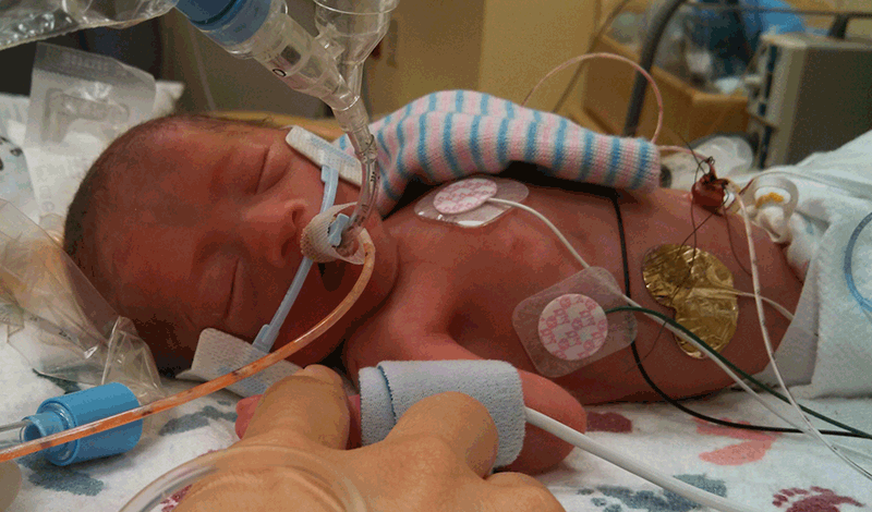 نوزاد دختر تازه&zwnj;متولد به دلیل مشکل تنفسی بستری شده است.