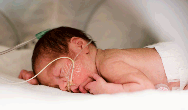 نوزاد تازه&zwnj;متولد به دلیل عفونت ریه و تنگی نفس بستری شده است.