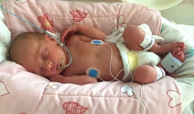 نوزاد تازه&zwnj;متولد به دلیل انسداد مجاری تنفسی بستری شده است.