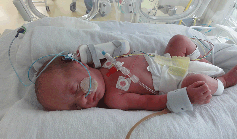 نوزاد تازه&zwnj;متولد به دلیل آنوس بسته بستری شده است.