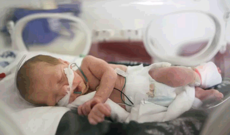 نوزاد&nbsp;تازه&zwnj;متولد به دلیل&nbsp;عفونت ریه بستری شده است.