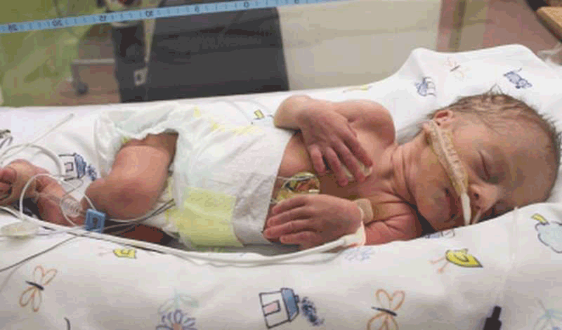 نوزاد تازه&zwnj;متولد به دلیل&nbsp;دیسترس&nbsp;تنفسی بستری شده است.