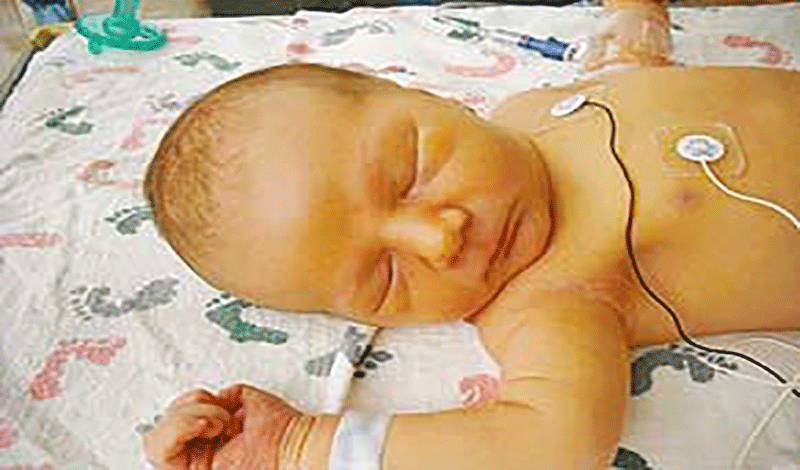 نوزاد تازه متولد به دلیل زردی بستری شده است.