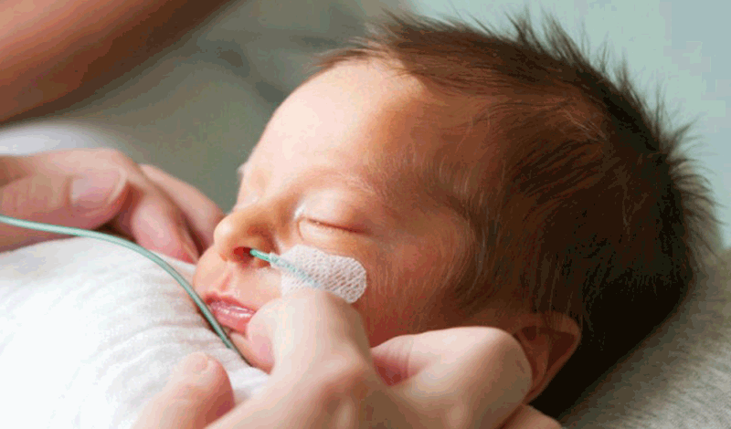 نوزاد تازه&zwnj;متولد به دلیل دیسترس تنفسی بستری شده است.