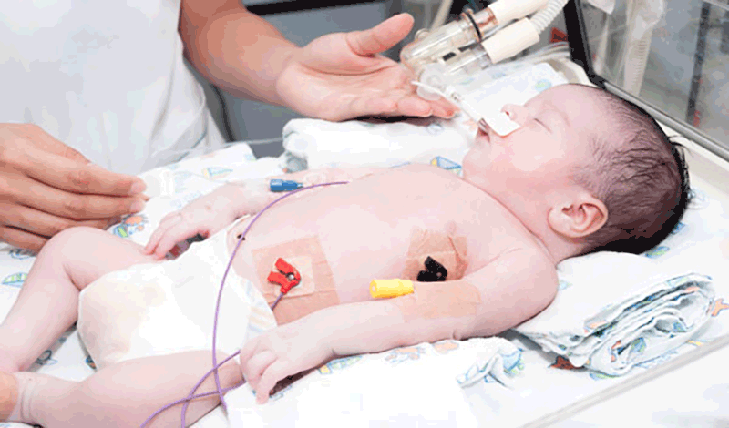 نوزاد&nbsp;یک ماهه به دلیل&nbsp;مشکلات تنفسی بستری شده است.