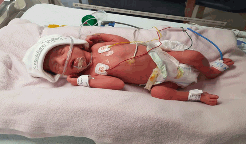 نوزاد&nbsp;تازه&zwnj;متولد به دلیل مشکل تنفسی بستری شده است.