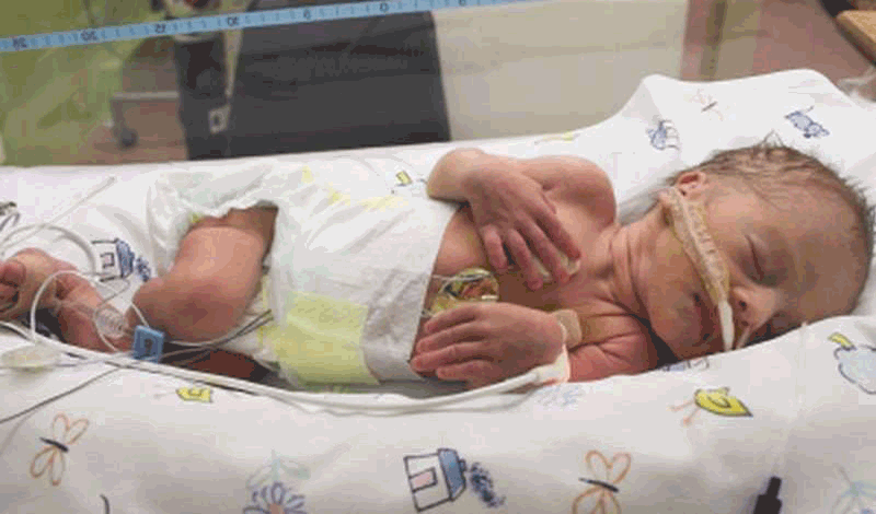 نوزاد تازه&zwnj;متولد به دلیل&nbsp;مشکل تنفسی بستری شده است.