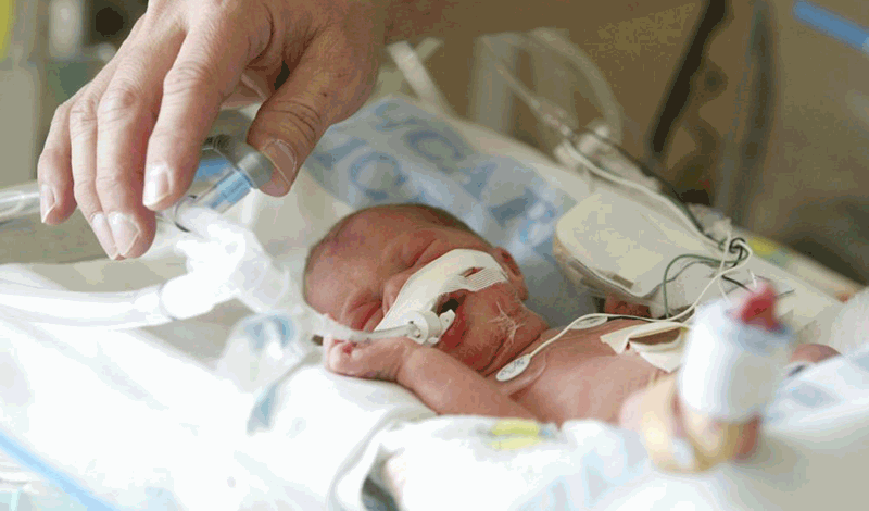 نوزاد تازه&zwnj;متولد به دلیل&nbsp;عفونت ریه بستری شده است.