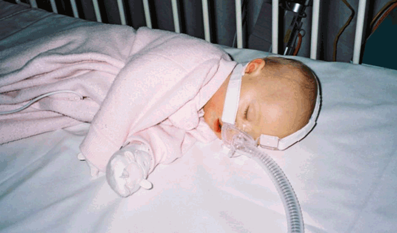 نوزاد&nbsp;تازه&zwnj;متولد به دلیل&nbsp;دیسترس تنفسی بستری شده است.
&nbsp;