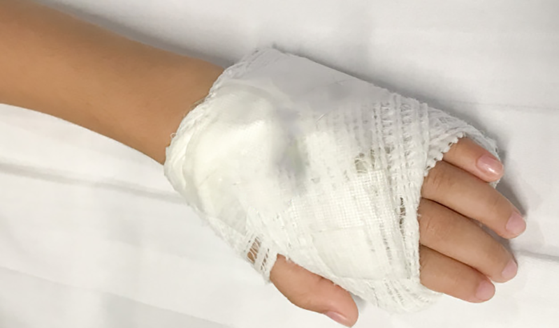 نادیا هشت&zwnj;ساله&nbsp;به دلیل جراحی انگشت دست بستری شده است.